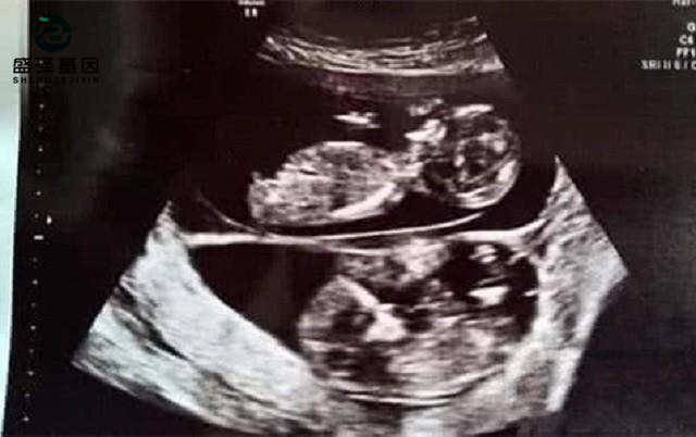 廣東男子做親子鑒定，竟發現自家雙胞胎有一個不是自己的？！